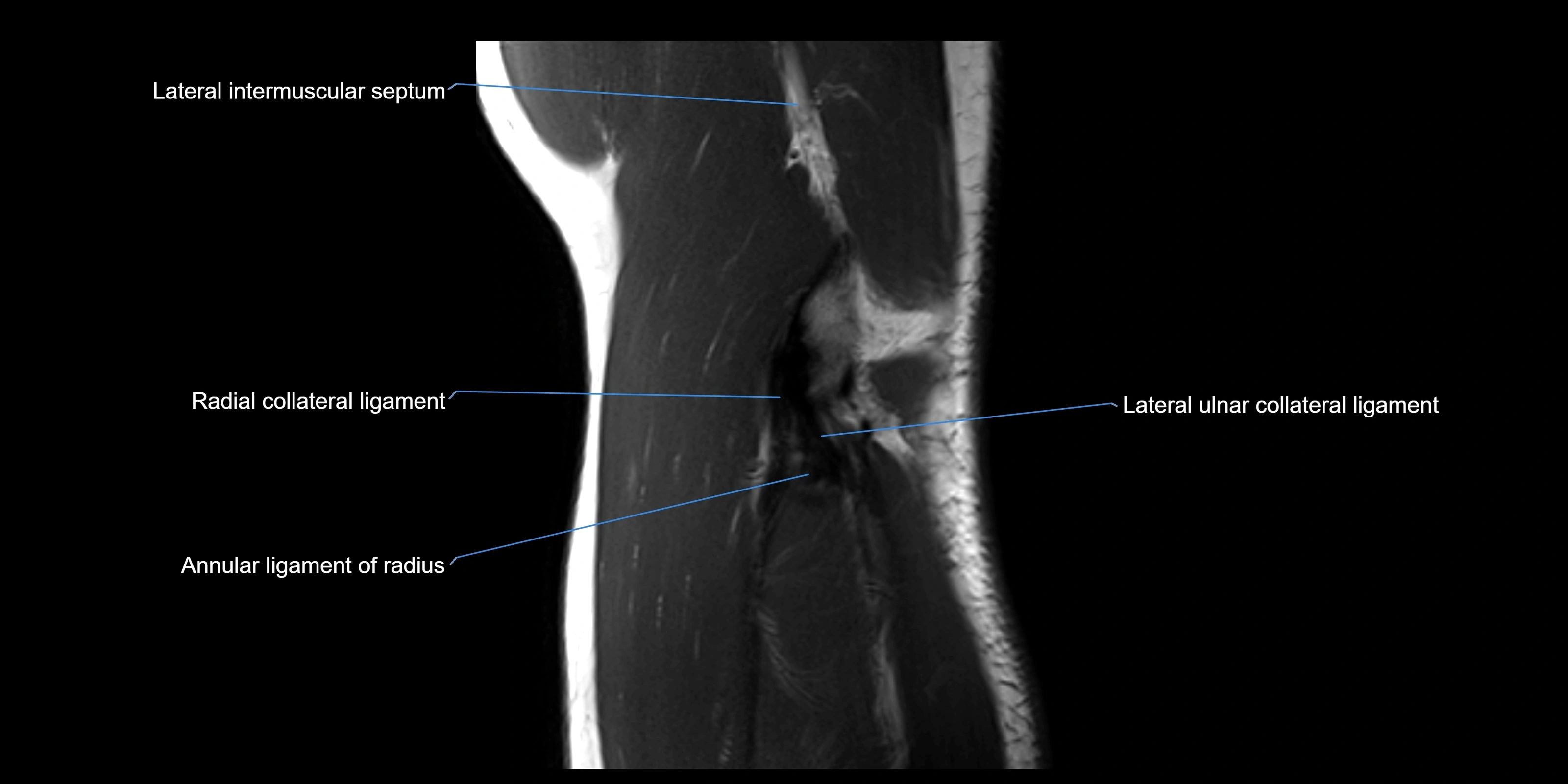 MRI elbow sagittal cross sectional anatomy 3T radiology  image-img-00001-00020.webp